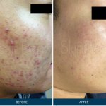 Microneedling PRP