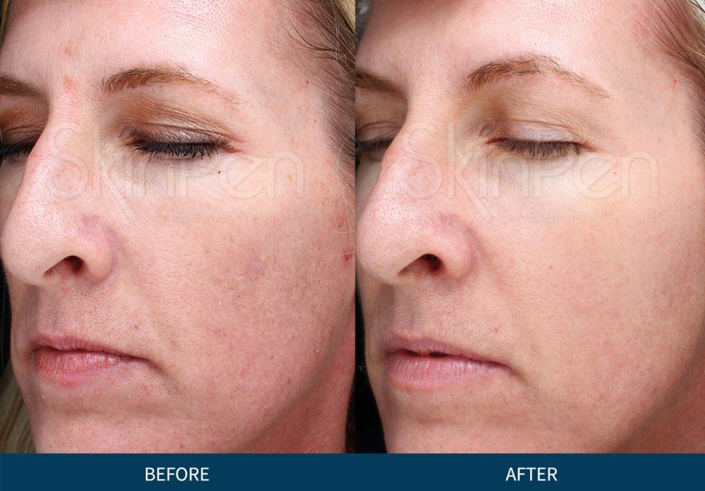 Microneedling PRP