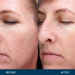 Microneedling PRP