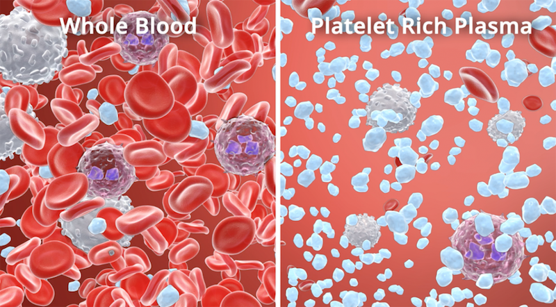 Whole Blood vs PRP