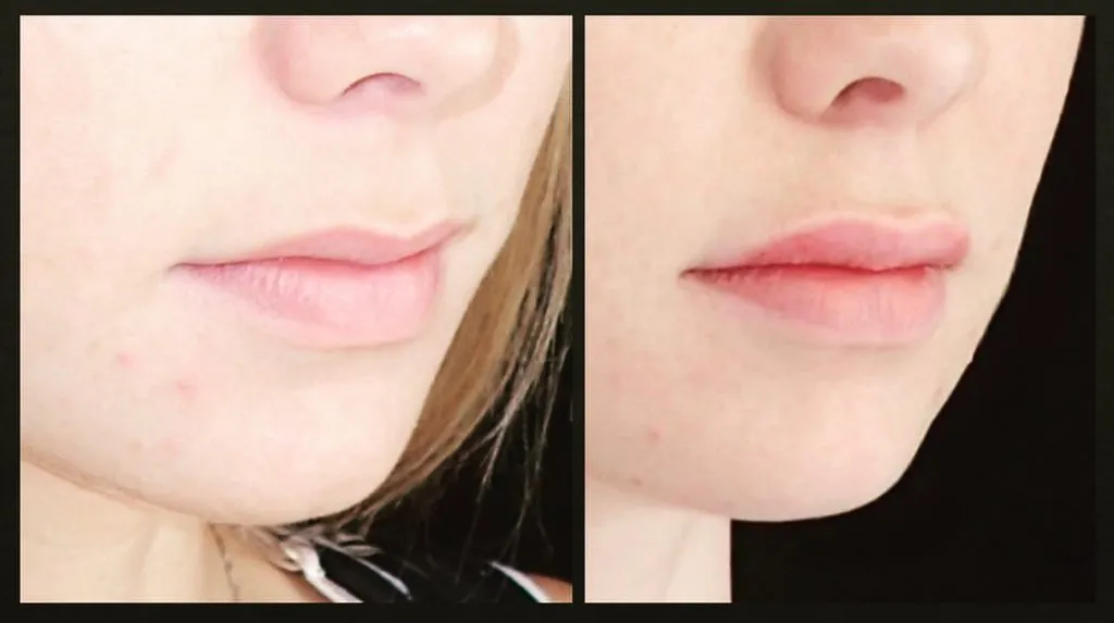 Before and after lip filler