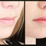 Before and after lip filler