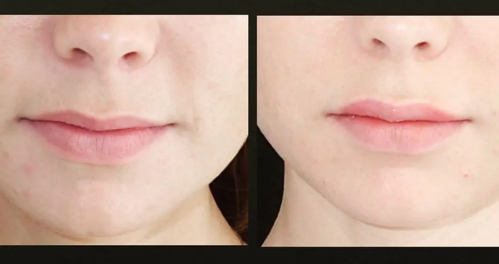 Front view of before and after lip filler