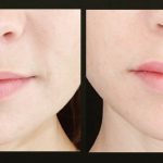 Front view of before and after lip filler