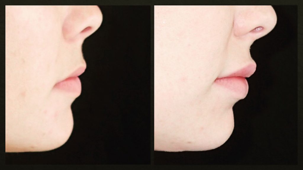 Side view of before and after lip filler