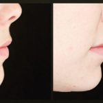 Side view of before and after lip filler