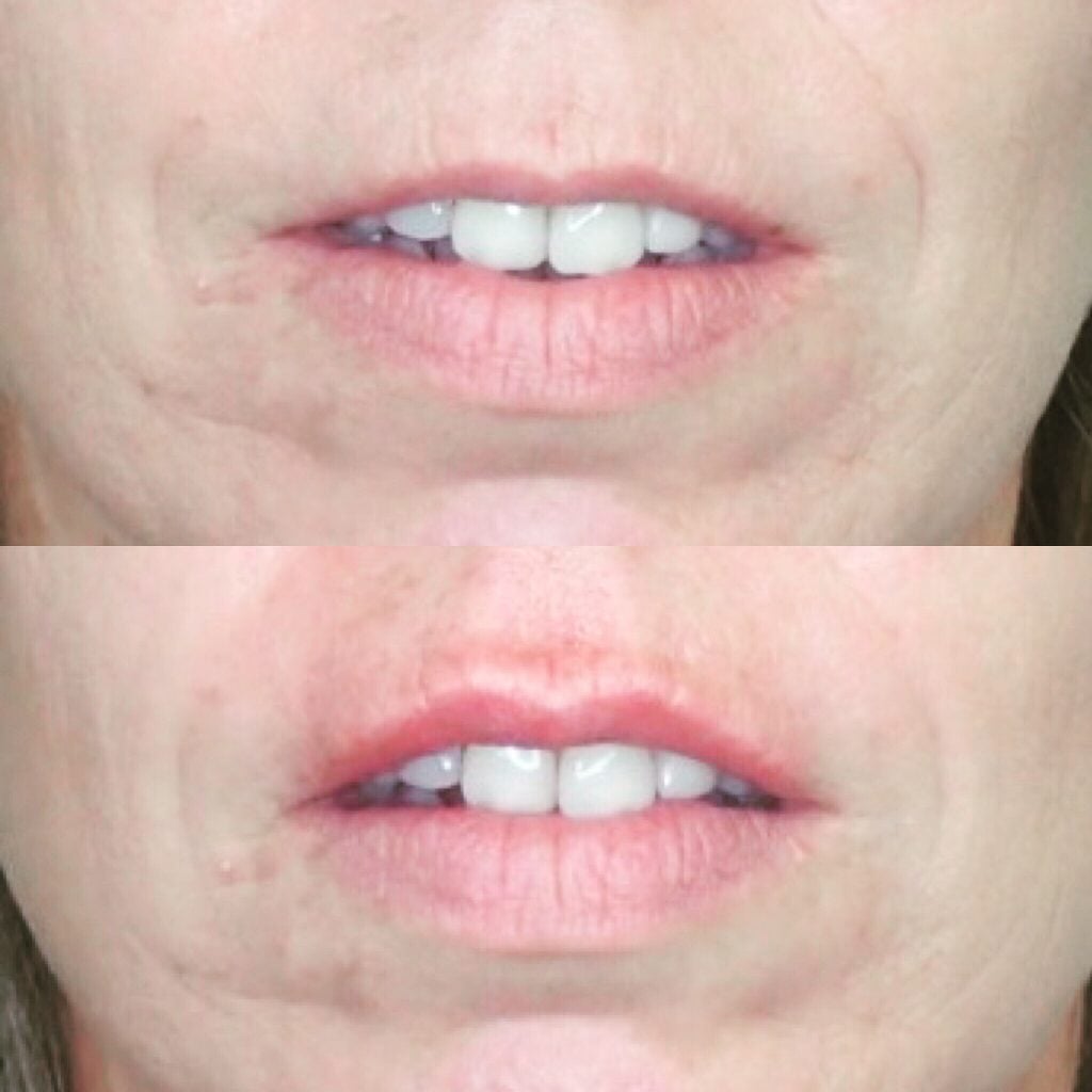 Front view of before and after lip filler