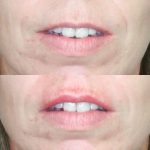 Front view of before and after lip filler