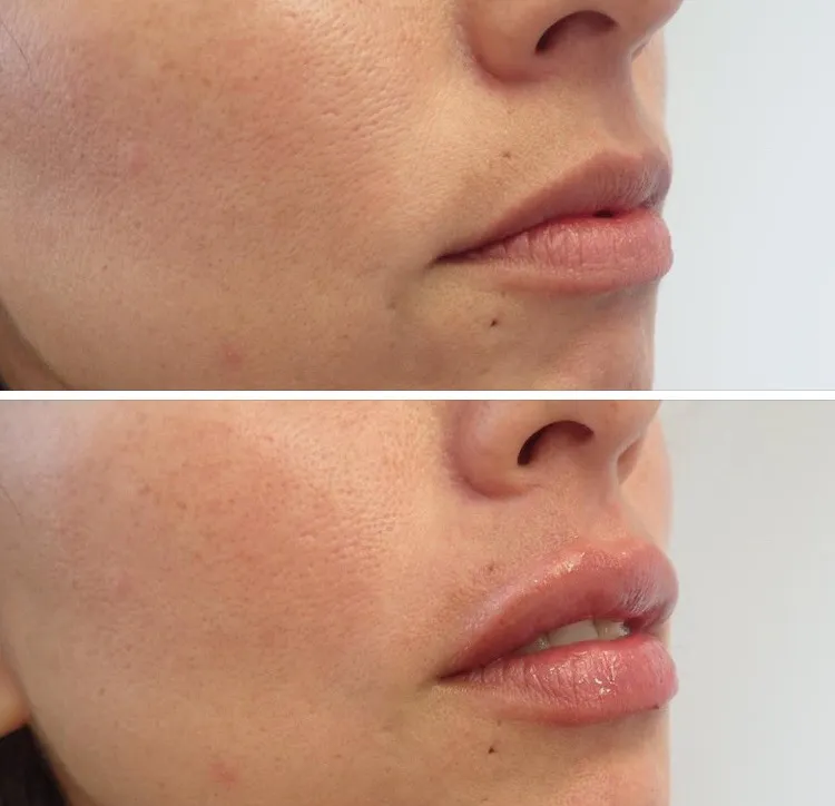 Side view of before and after lip filler