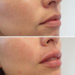 Side view of before and after lip filler