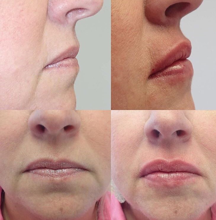 Side and front view of before and after lip filler