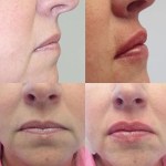 Side and front view of before and after lip filler