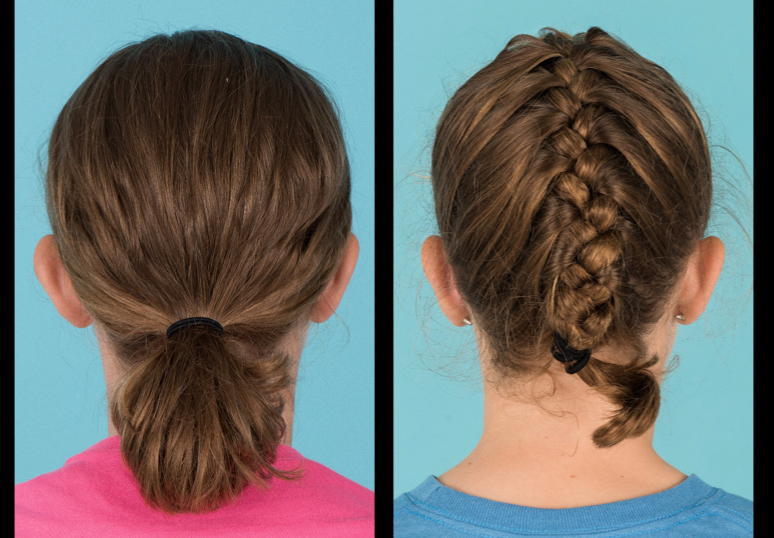 Back view of before and after otoplasty