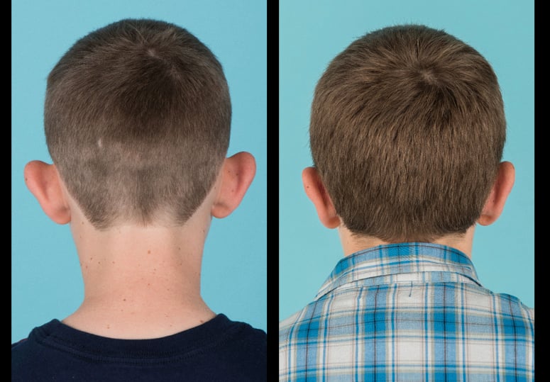 Back view of before and after otoplasty