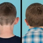 Back view of before and after otoplasty
