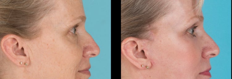 Side view of before and after nose surgery