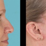 Side view of before and after nose surgery