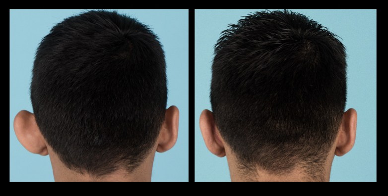 Back view of before and after otoplasty