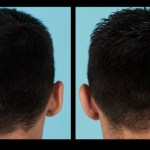 Back view of before and after otoplasty