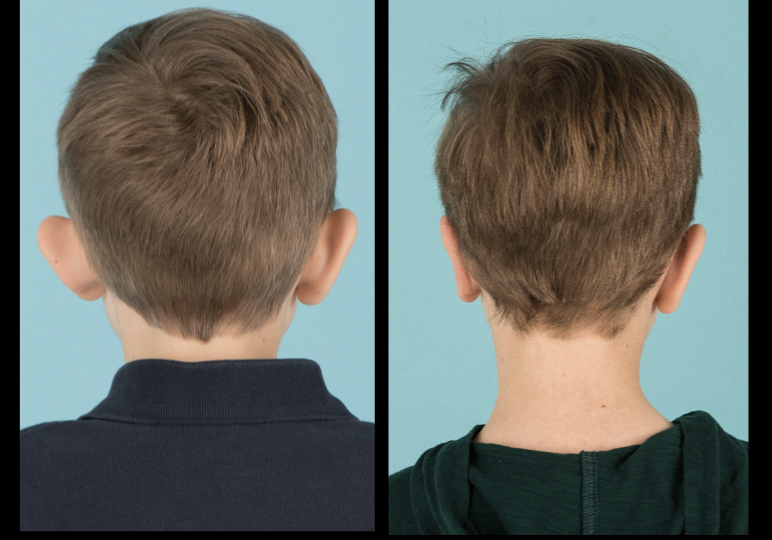 Back view of before and after otoplasty