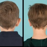 Back view of before and after otoplasty
