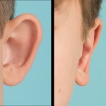 Left ear before and after otoplasty