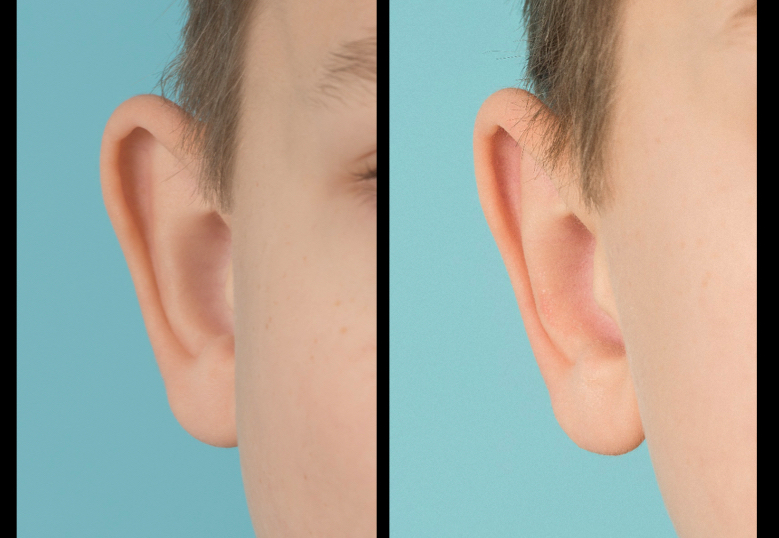 Right ear before and after otoplasty