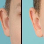 Right ear before and after otoplasty