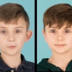 Front view of before and after otoplasty