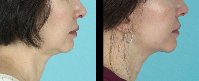 Side view of before and after a neck lift