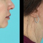 Side view of before and after a neck lift
