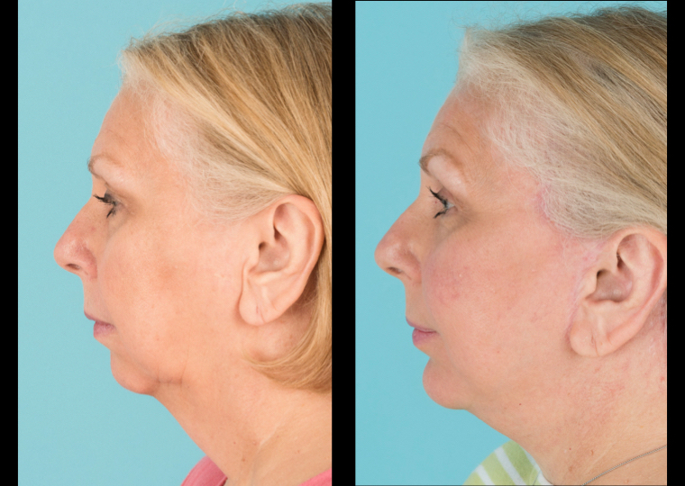 Before and after a chin implant
