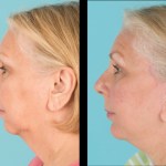 Before and after a chin implant