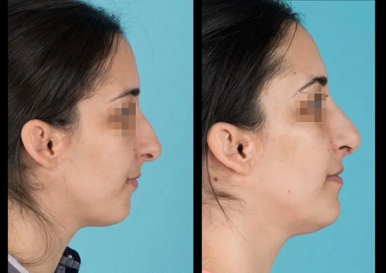 Side view of before and after nose surgery