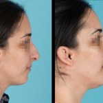 Side view of before and after nose surgery