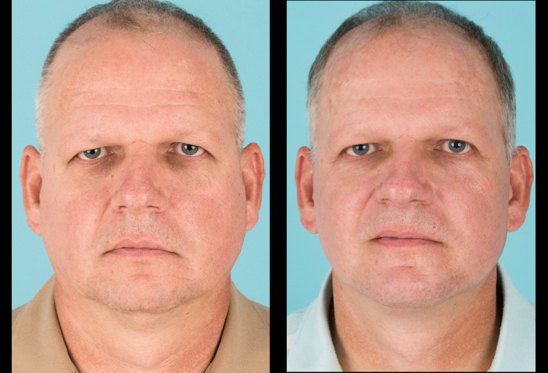 Front view of before and after cosmetic surgery for men