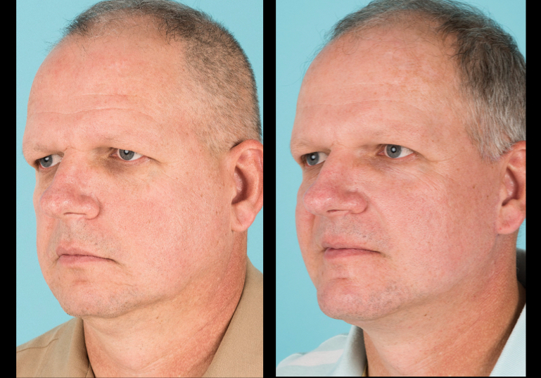 Before and after cosmetic surgery for men