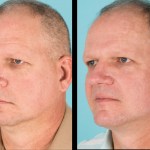 Before and after cosmetic surgery for men