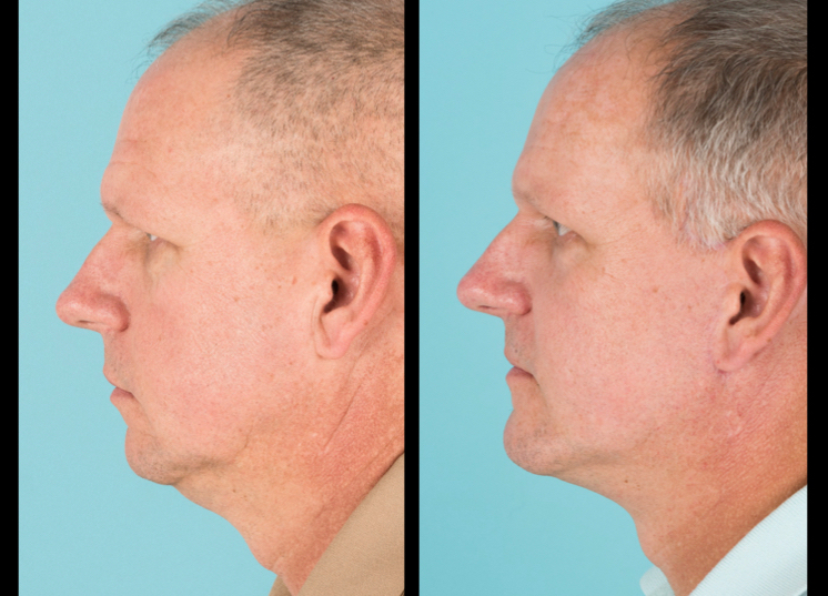 Side view of before and after cosmetic surgery for men