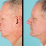 Side view of before and after cosmetic surgery for men