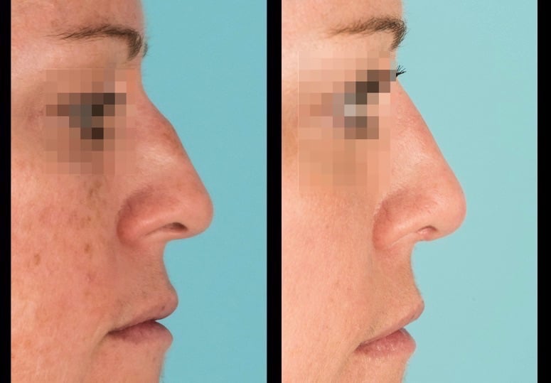 Side view of before and after nose surgery