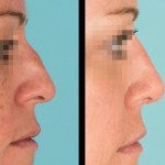 Side view of before and after nose surgery
