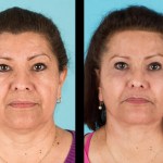Front view of before and after cheek implants