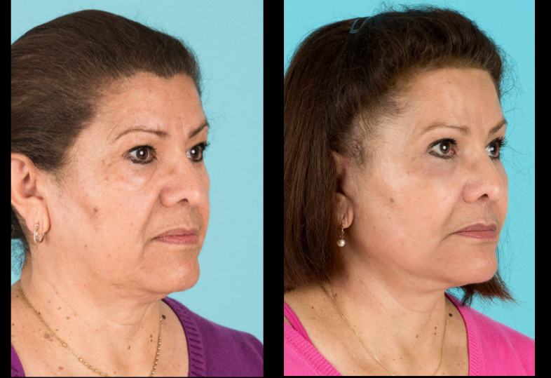 Before and after cheek implants