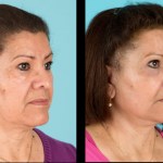 Before and after cheek implants