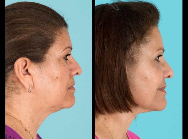 Side view of before and after cheek implants