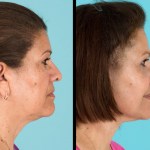 Side view of before and after cheek implants