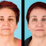 Front view of before and after cheek implants