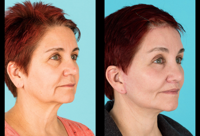 Before and after cheek implants