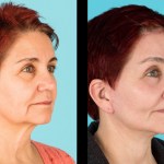 Before and after cheek implants